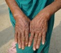 West Bengal, India: Arsenic Lesion 