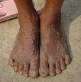 West Bengal, India: Arsenic Lesion 